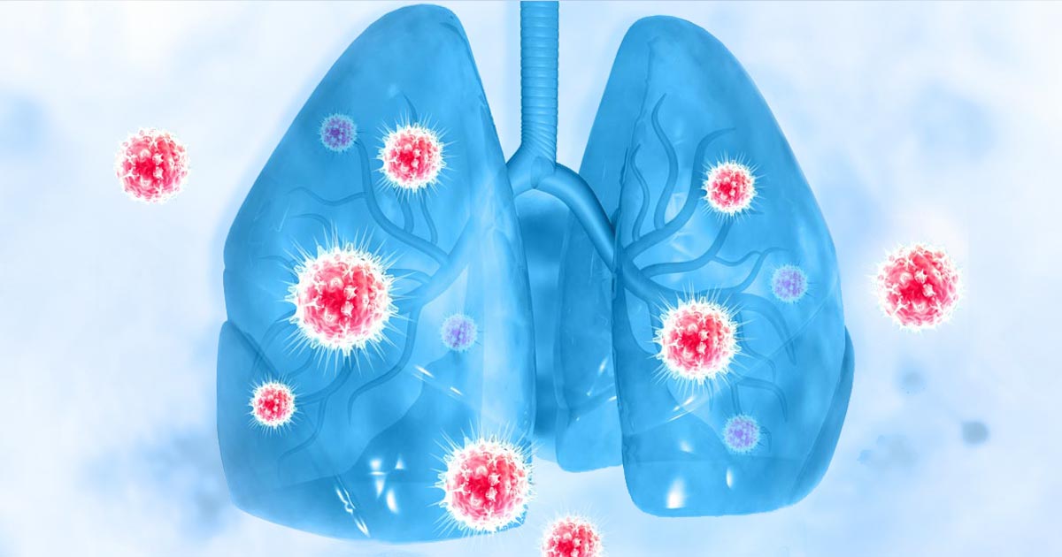 asco20肺癌采用肺癌的原始图像