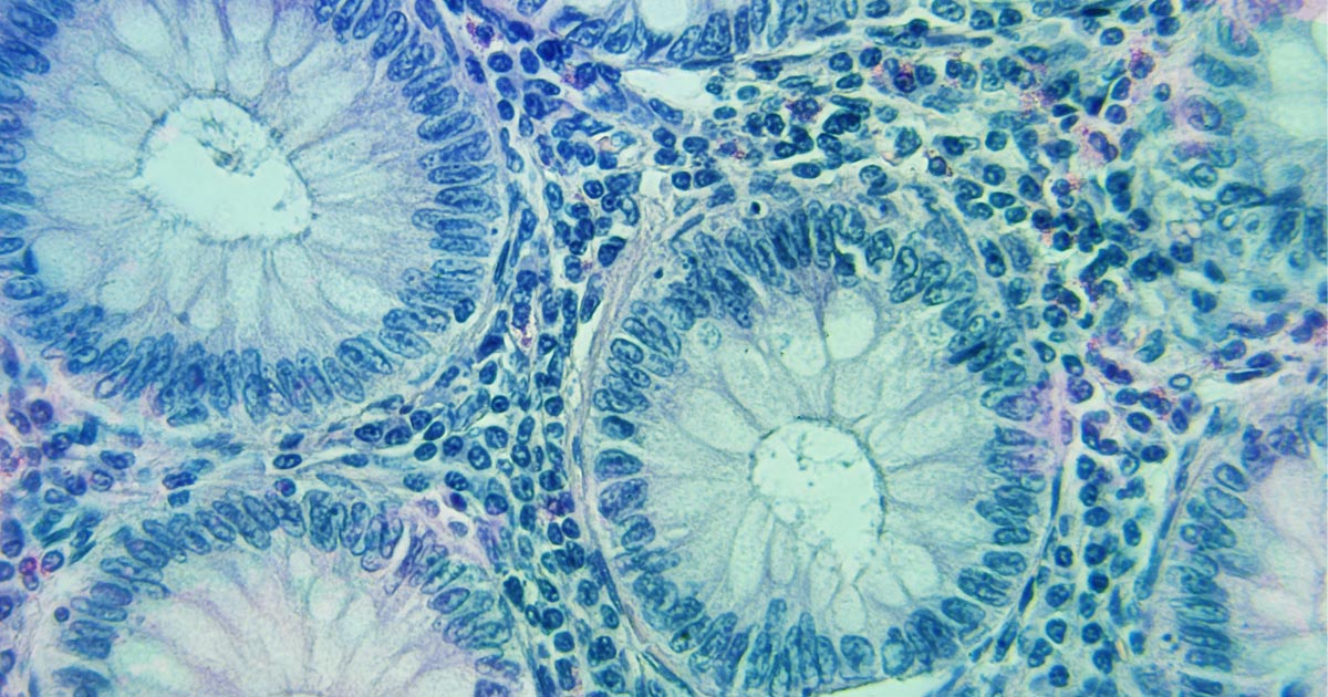Image of gatrointestinal cancer cell