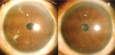 临床影像比较PDEK眼睛和正常眼睛的同胞