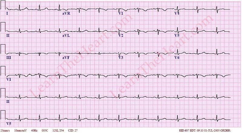 不完全右束支传导阻滞 Rbbb 心电图 例1 了解心脏 雷电竞raybet 雷电竞下载苹果版 雷电竞官方网址 不完全右束支传导阻滞 Rbbb 心电图 例1 了解心脏 雷电竞raybet 雷电竞下载苹果版 雷电竞官方网址